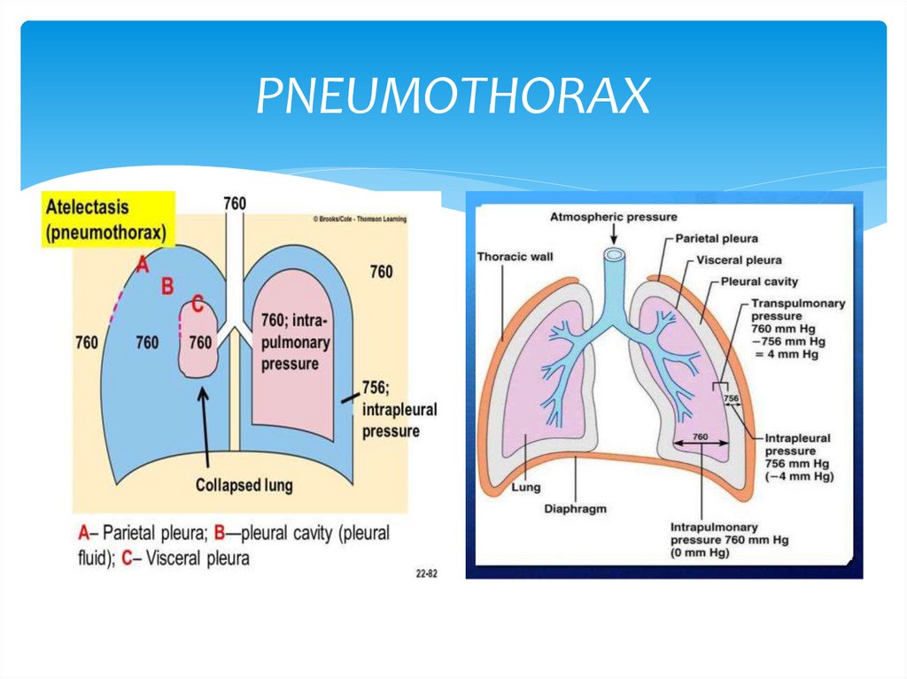 Пневмоторакс картинки для презентации