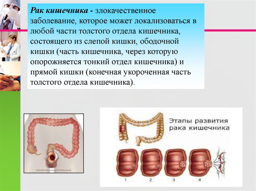 Сколько кишечников в организме человека. Прямая кишка заболевания опухолевые. Злокачественная опухоль слепой кишки.