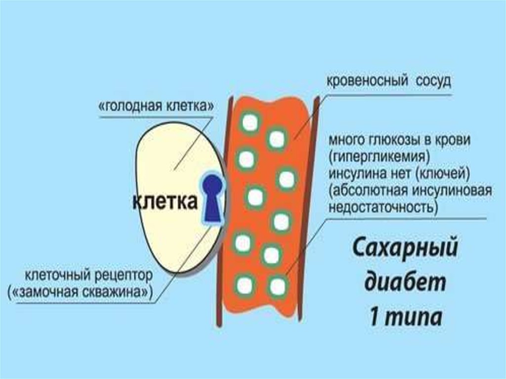 Механизм диабета 1 типа. Сахарный диабет 1 типа. Диабет первого типа. Механизм сахарного диабета. Сахарный диабет 2 типа.