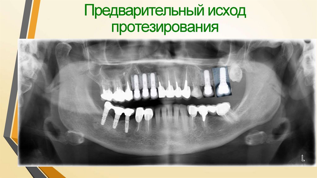 Предварительный исход протезирования