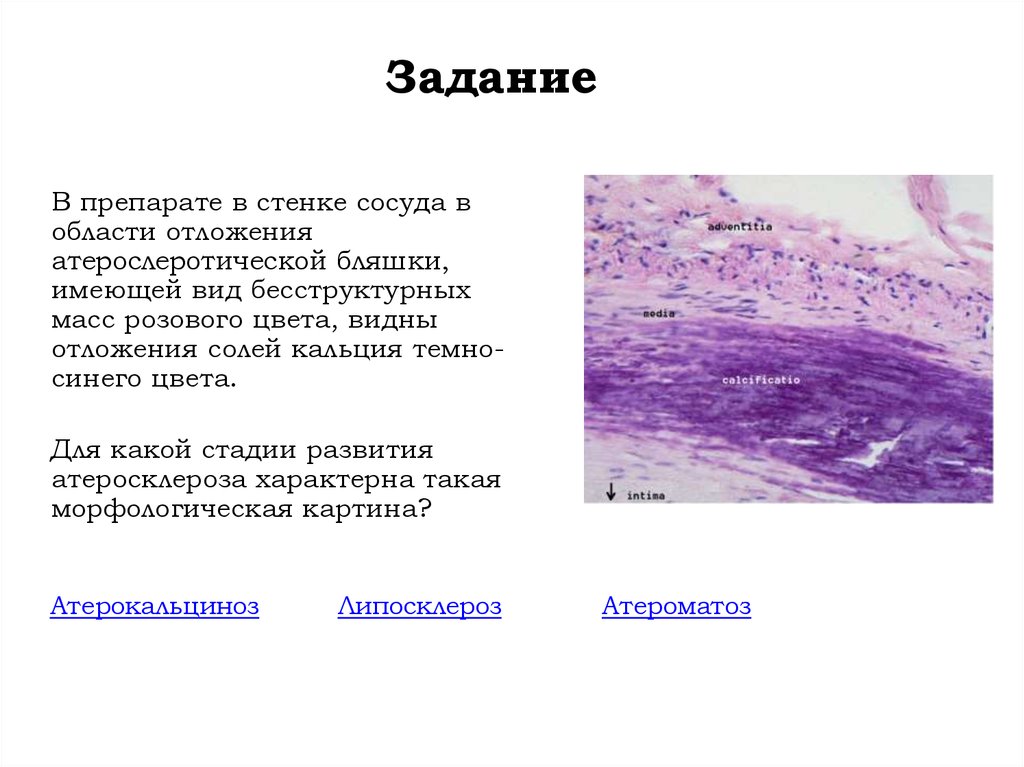 Солей кальция. Соли кальция в простате. Осумкованная гематома соли кальция. Инкрустируют соли кальция.