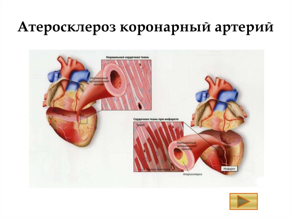 Ишемическая болезнь сосудов. ИБС атеросклероз коронарных артерий. Атеросклеротическое поражение коронарных артерий. Стенозирующий коронарный атеросклероз. Атеросклероз венечных артерий сердца.