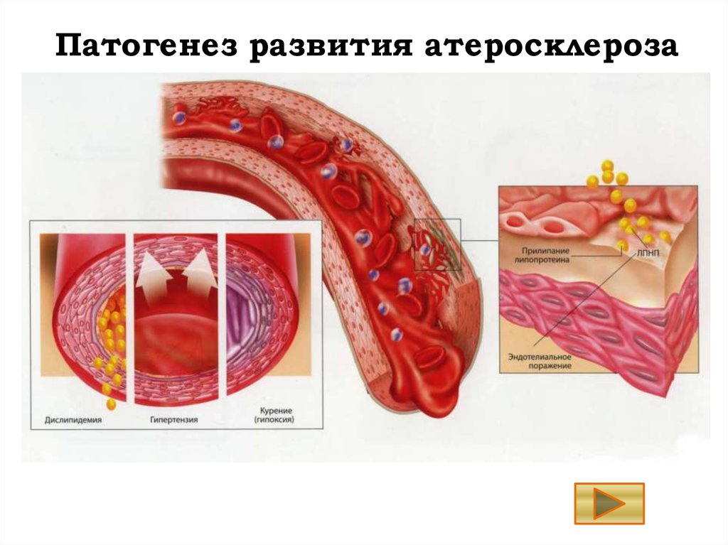 Атеросклероз картинки для презентации