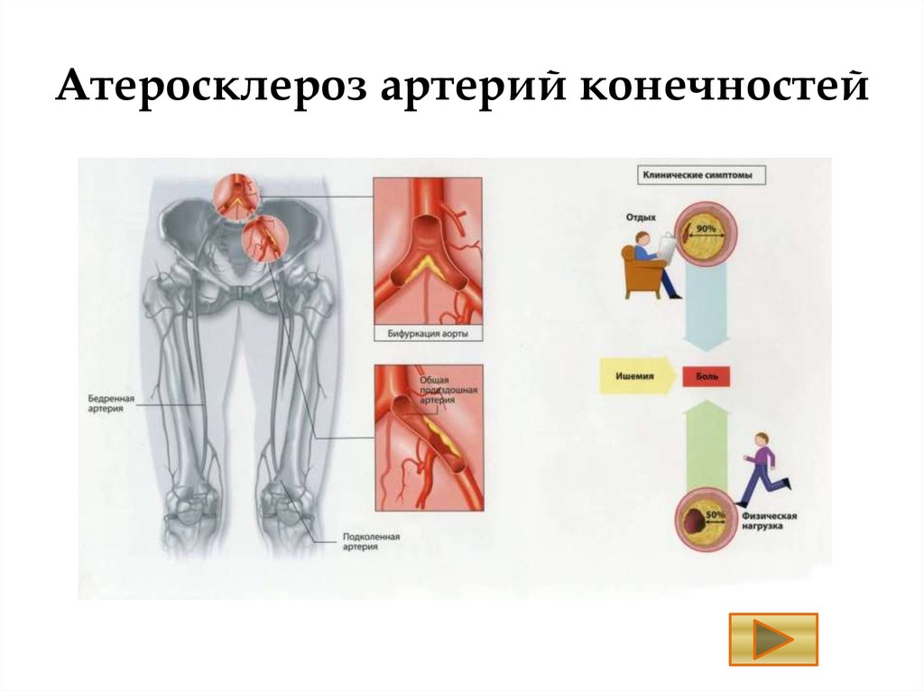 Осложнения атеросклероза тест