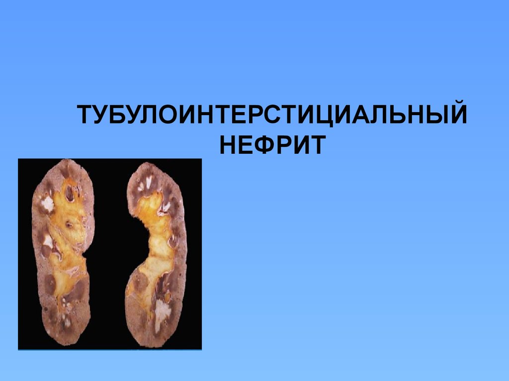 Реферат: Хронический пиелонефрит Тубулоинтерстициальный нефрит
