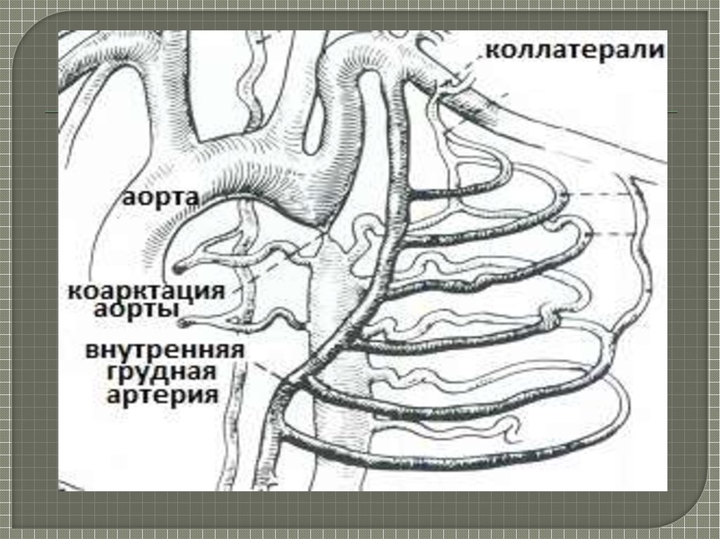 Внутренняя грудная. Конечные ветви внутренней грудной артерии. Межреберные ветви внутренней грудной артерии. Внутренняя грудная артерия схема. Прободающие ветви внутренней грудной артерии кровоснабжают.