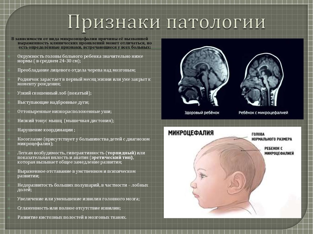 Болезни мозга названия. Морфофункциональная незрелость головного мозга новорожденного это. Микроцифалияголовного мозга. Микроцефалия головного мозга у ребенка. Череп микроцефальной формы.