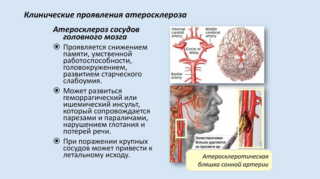 Заболевания сосудов головы. Клинические проявления атеросклероза сосудов головного мозга. Клинические проявления атеросклероза мозговых артерий. Атеросклеротическое поражение магистральных артерий головы. Атеросклероз магистральных артерий головы симптомы.