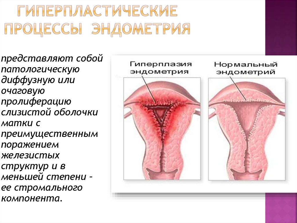 Гиперплазия эндометрия матки презентация