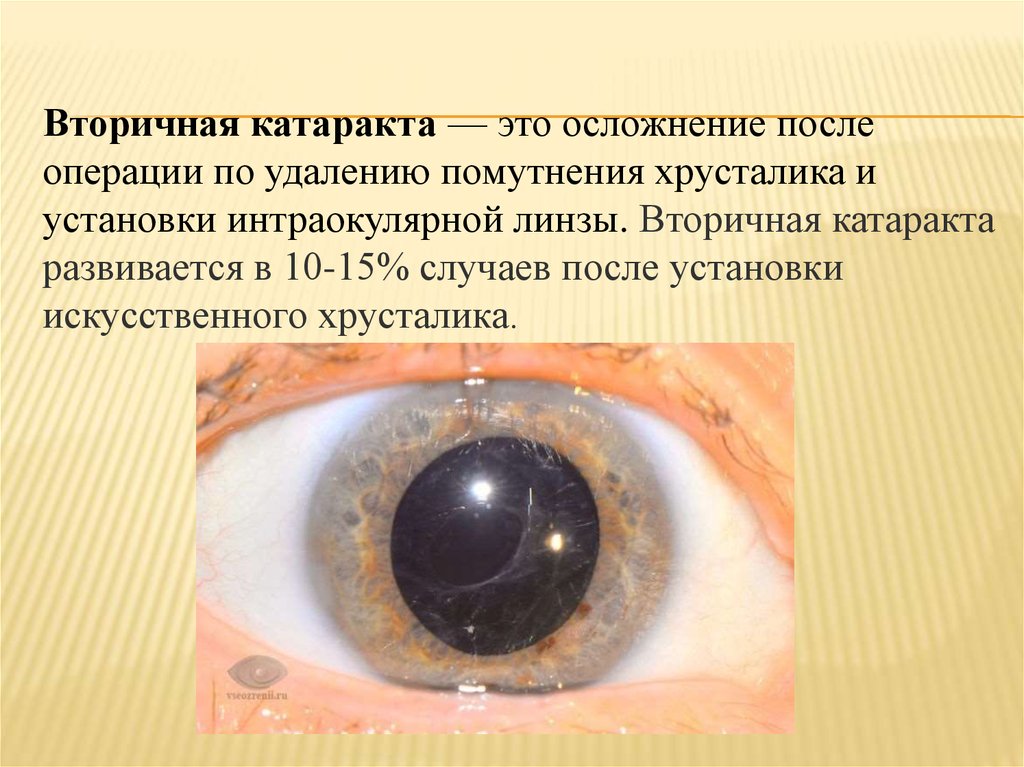Когда после замены хрусталика восстанавливается зрение глаза. Вторичная пленчатая катаракта. Вторичная катаракта помутнение задней капсулы. Шары Эльшнига вторичная катаракта. ИОЛ вторичная катаракта.