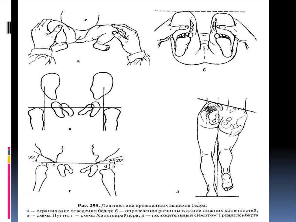 Схема врожденного вывиха бедра