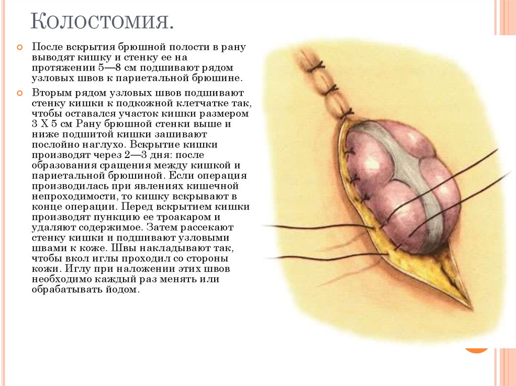 Колостомия.