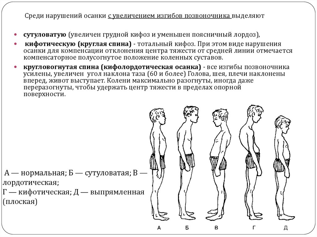 Статистика нарушения осанки