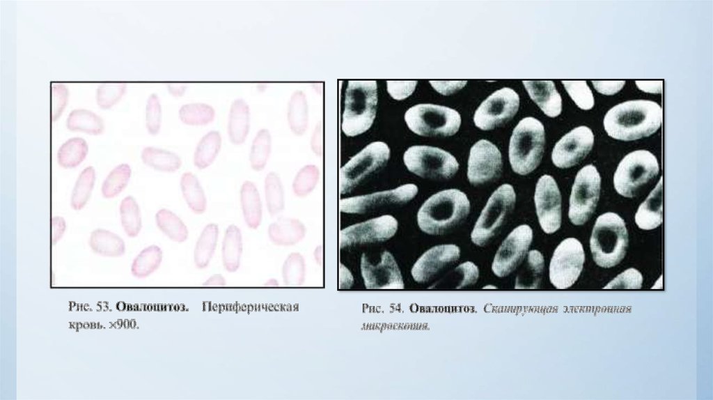 Эллиптоцитоз. Наследственный эллиптоцитоз. Гемолитическая анемия овалоцитоз. Овалоцитарная анемия овалоцитоз. Наследственный овалоцитоз.