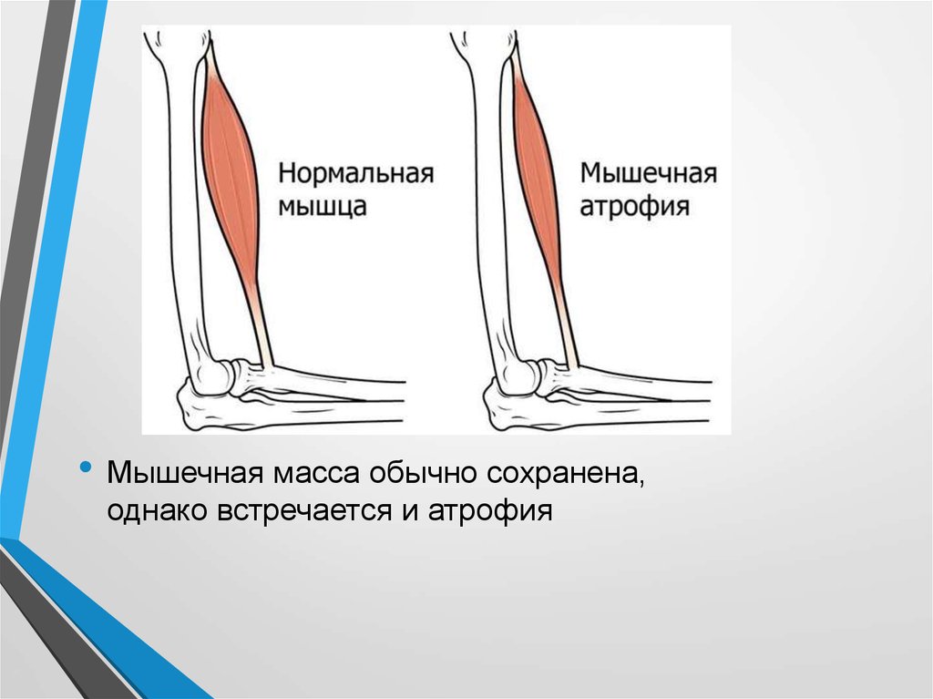 Атрофия мышц. Атрофированная мышца на ноге.