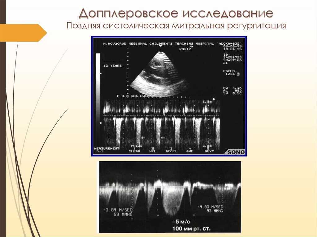 Градиенты на клапанах. Допплеровское исследование. Митральная регургитация про систолическая. Допплеровское исследование сердца. Оценка кровотока на митральном клапане.