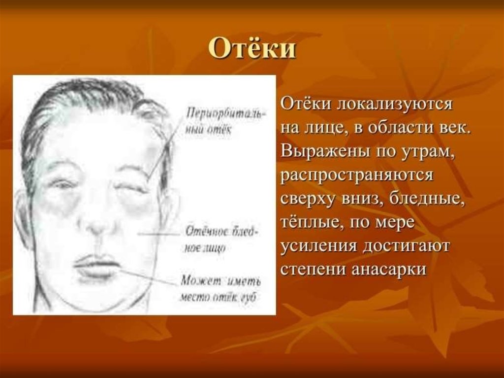 Отечный синдром характерен для. При локализации отеков на лице. Отеки при заболеваниях почек.