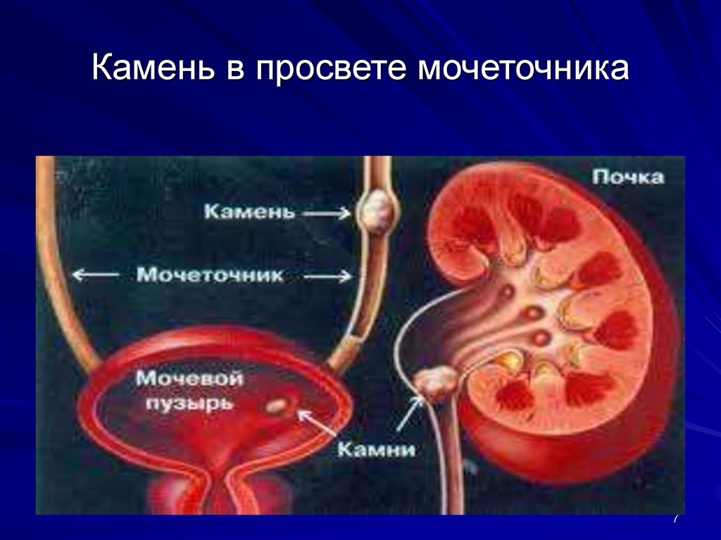 Мочеточник соединяет почку с