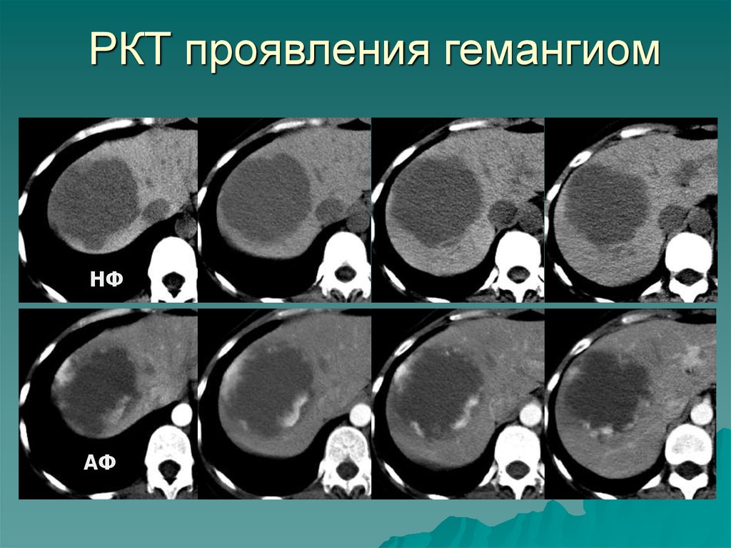 Гемангиомы в уз изображении характеризуются тест