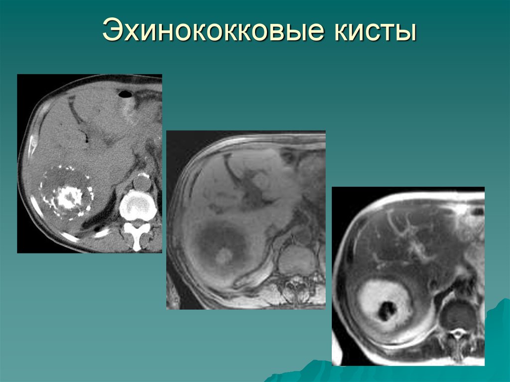 Эхинококковая киста печени в ультразвуковом изображении характеризуется