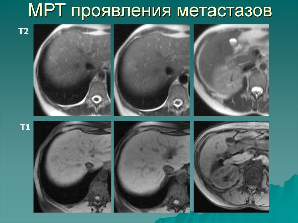 Как выглядят метастазы в печени на кт с контрастом фото