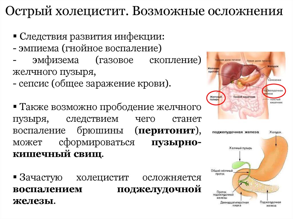 Острый холецистит карта