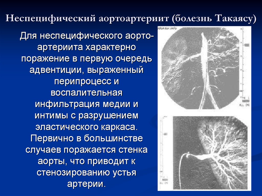 Артериит такаясу презентация