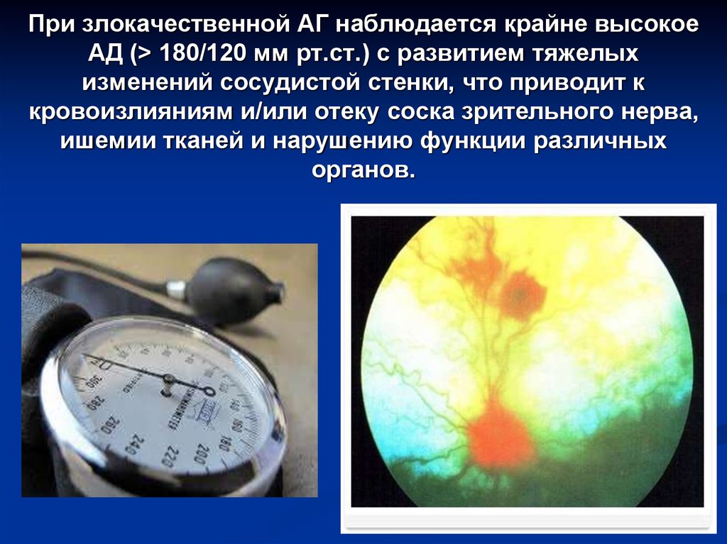 Вазоренальная гипертензия презентация