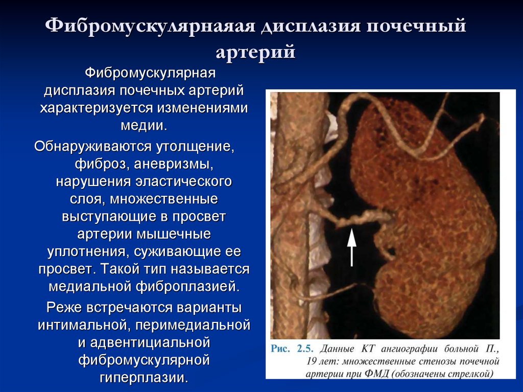 Дисплазия почки презентация