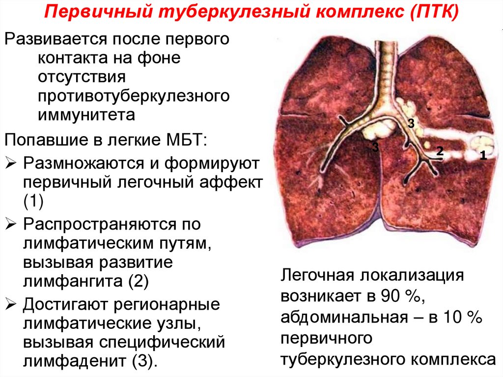 Первичный туберкулезный комплекс (ПТК)