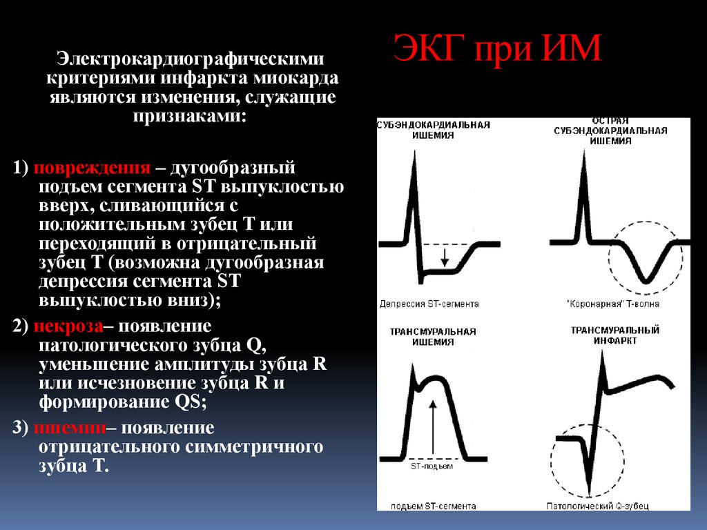 Критерии ишемии. Стадии трансмурального инфаркта миокарда на ЭКГ. ЭКГ при трансмуральном инфаркте. ЭКГ передне перегородочный инфаркт. Острый трансмуральный инфаркт ЭКГ.
