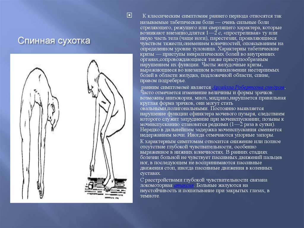 Для клинической картины спинной сухотки характерно наличие