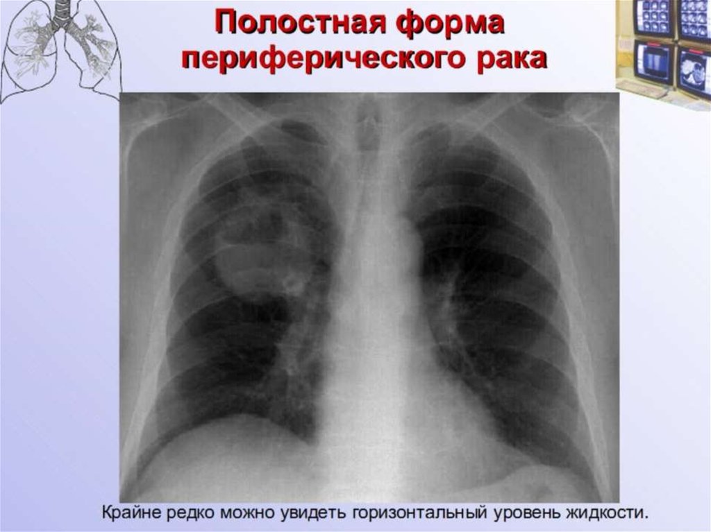 Образование в легком. Округлое образование в легких. Полостные образования в легких рентген. Периферическое образование в легких что это. Периферические образования легких на рентгене.