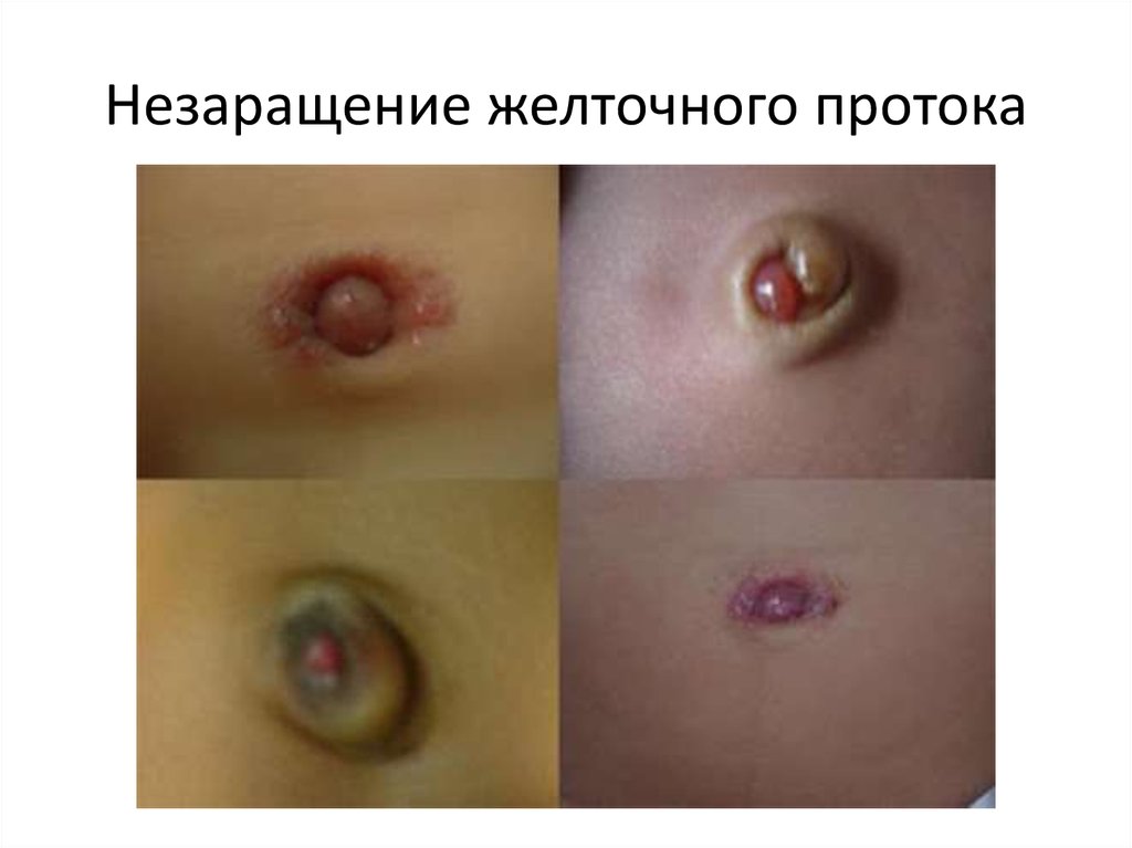 Незаращение желточного протока