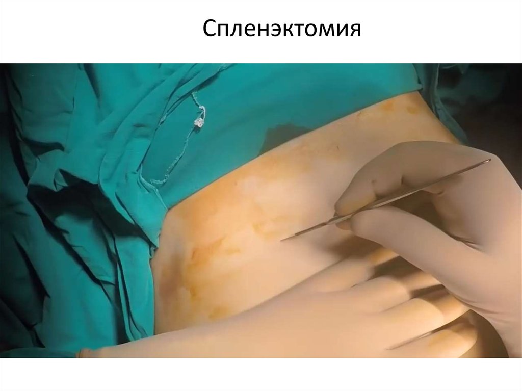 Спленэктомия