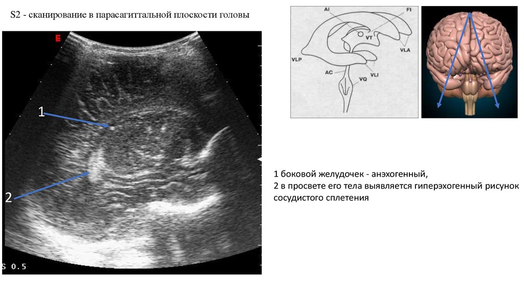 Гиперэхогенный фокус. УЗИ головного мозга нейросонография. НСГ боковые желудочки. УЗИ анатомия НСГ. Нейросонография анатомия.