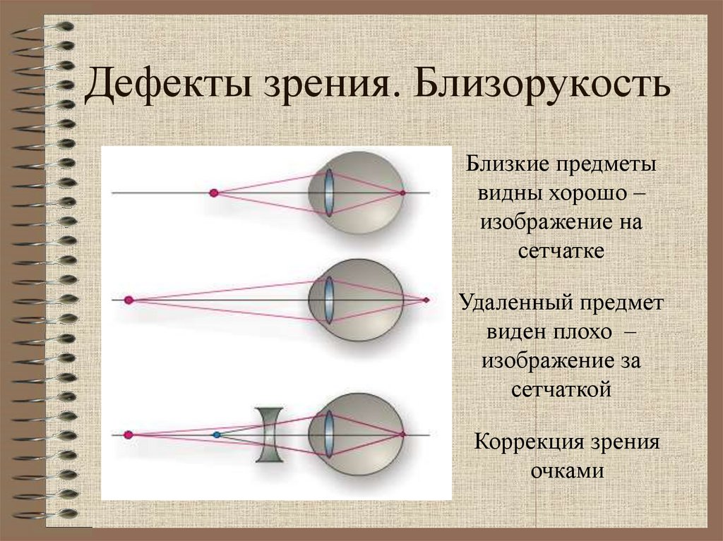 Исправление близорукости физика рисунок