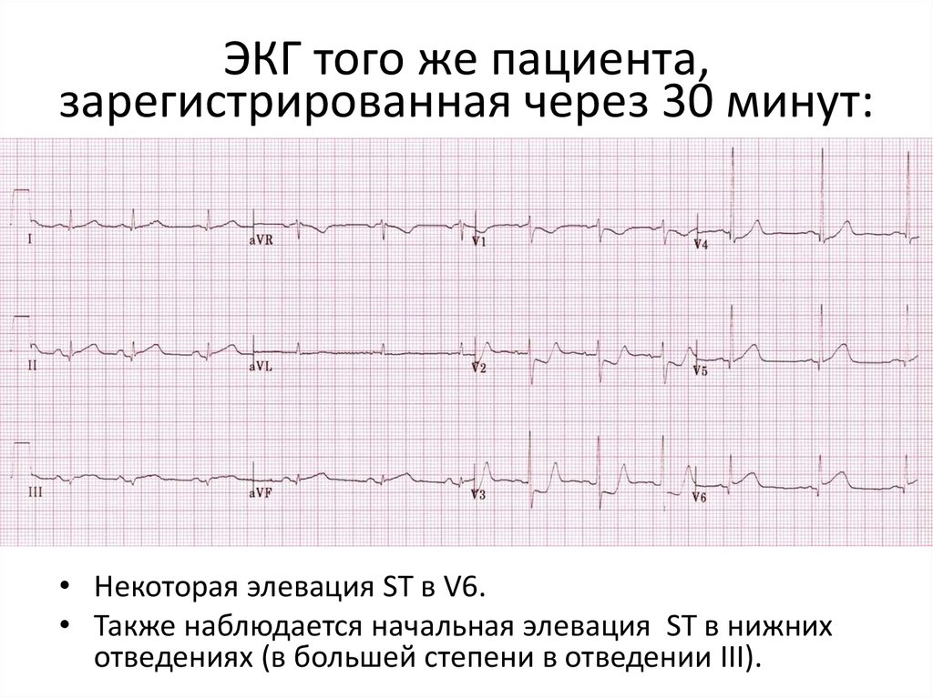 Как выглядит экг при инфаркте миокарда фото с расшифровкой