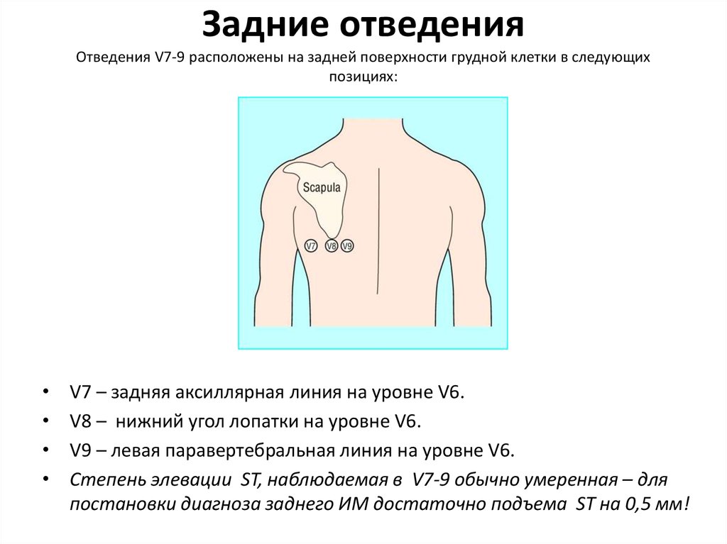 Установка холтера схема наложения 10 электродов