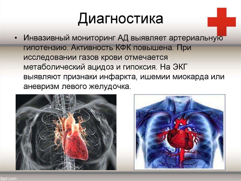 Кардиогенді шок презентация