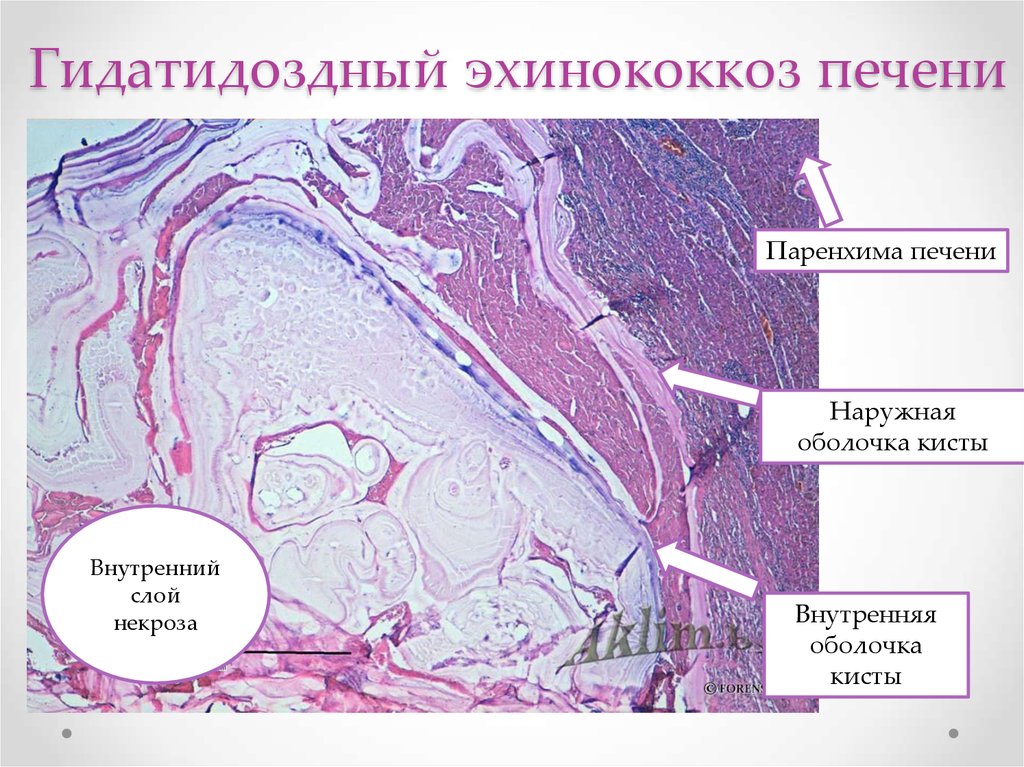 Протоковые изменения в печени. Однокамерный эхинококкоз печени. Однокамерный эхинококк печени микропрепарат. Многокамерный эхинококкоз печени микропрепарат. Эхинококкоз печени патоморфология.