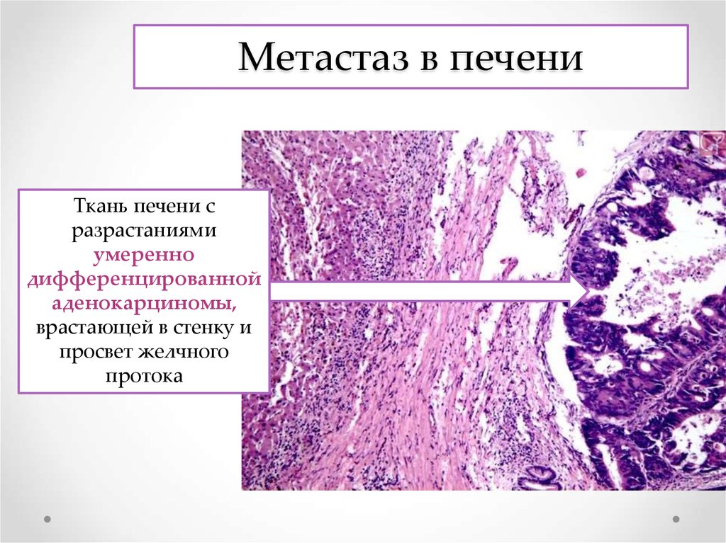 Аденокарцинома печени 4 стадия прогноз. Метастазы в печени гистология. Метастаз аденокарциномы микропрепарат. Метастазы аденокарциномы гистология. Метастаз печень патологическая анатомия.