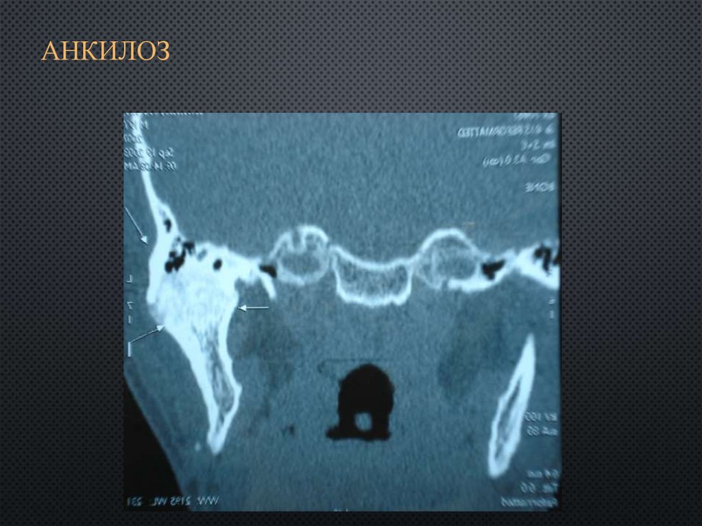Анкилоз лечение. Костный анкилоз ВНЧС рентген. Анкилоз ВНЧС рентгенография. Костный анкилоз челюстного сустава.