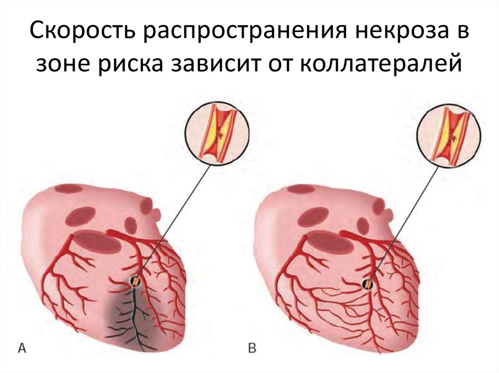 Окс нестабильная стенокардия