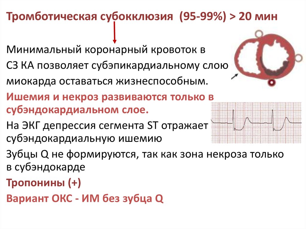 Нестабильная стенокардия карта вызова