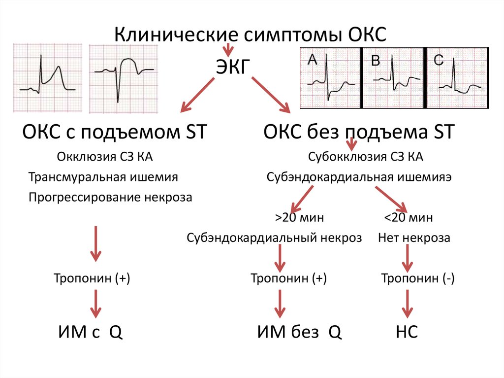 Окс нестабильная стенокардия