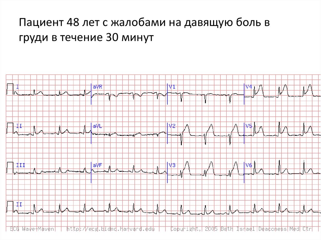 Окс нестабильная стенокардия