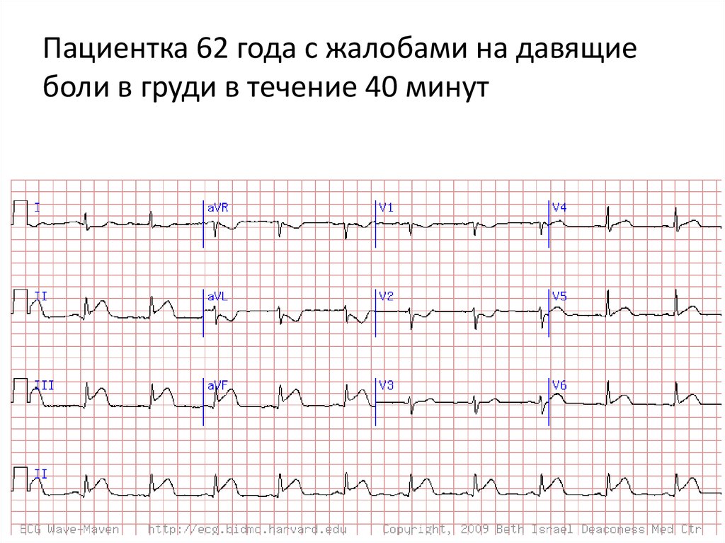 Острый коронарный синдром карта вызова