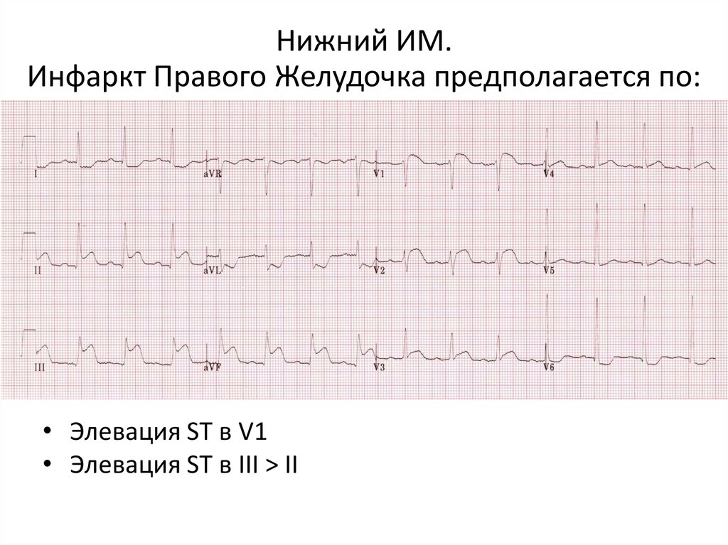 Как выглядит инфаркт на кардиограмме фото