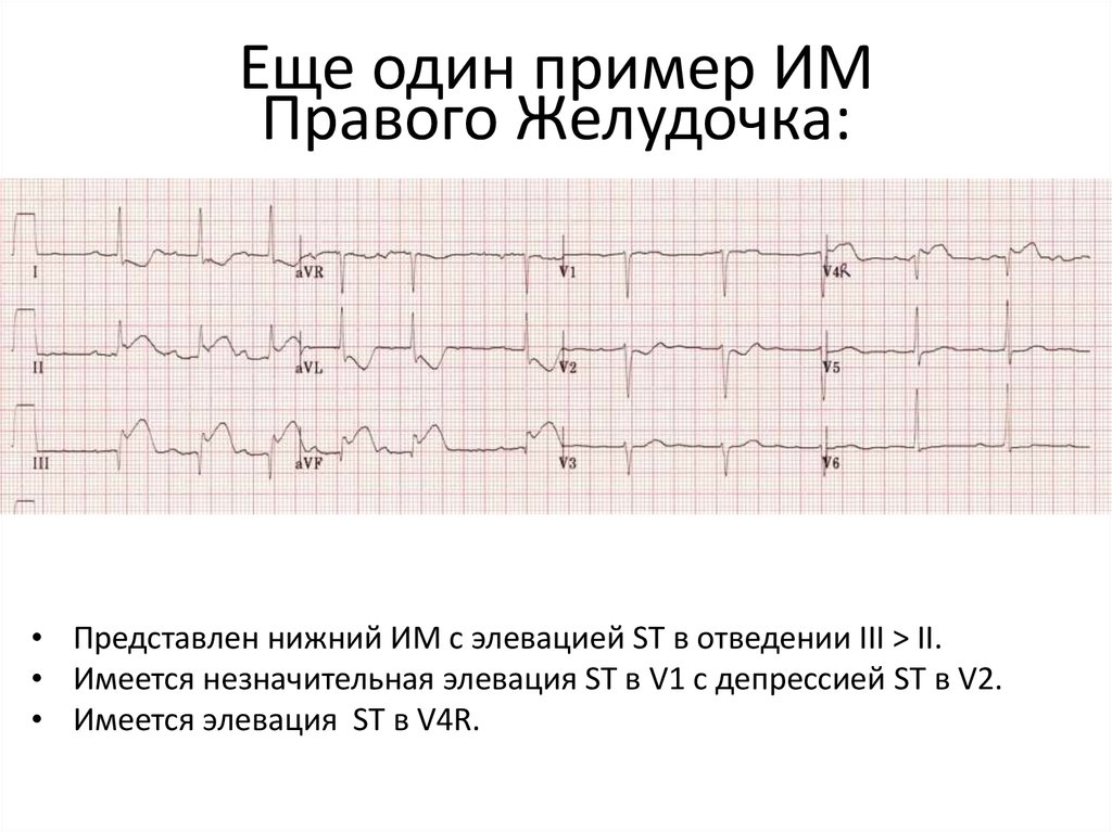 Как выглядит инфаркт на кардиограмме фото